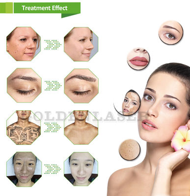 Experience Smooth and Hair-Free Skin with Diode Laser Hair Removal Machine