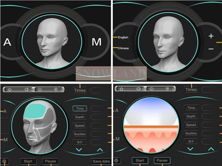 Ημιαγωγός 808nm Laser Diode Laser Machine Αποτρίχωσης με αισθητήρα επαφής με το δέρμα που εξασφαλίζει ταχεία θεραπεία αποτρίχωσης